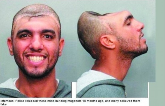 美国"半脑哥"自揭"半脑之谜"