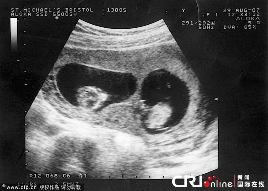 英国神奇妈咪有两个子宫 孕育龙凤胎创奇迹(高清组图)