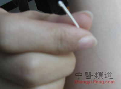 说说针灸如何通过针刺穴位镇痛