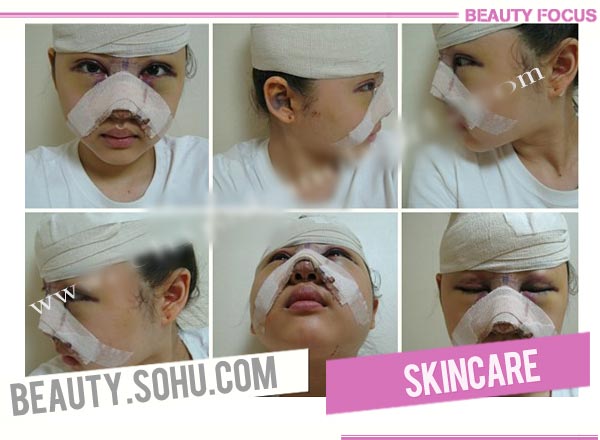 双眼皮手术+隆鼻手术+额头手术+颜面轮廓整形手