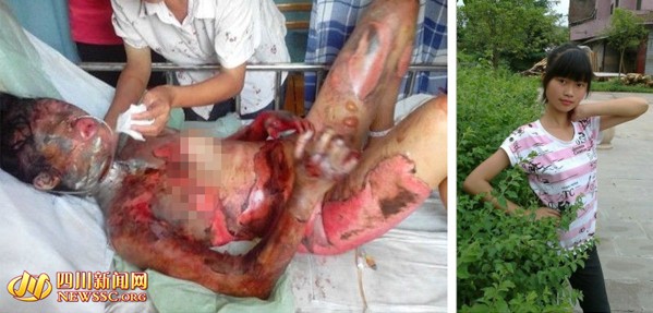 四川大竹<em>17岁少女</em>被开水烫伤如被剥皮 双手面