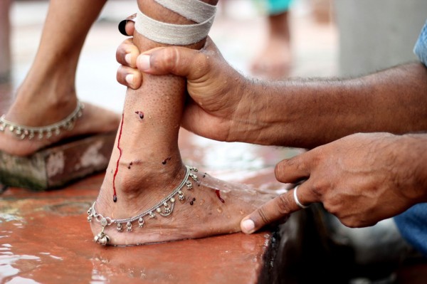 揭秘印度传统"放血"疗法【高清组图】