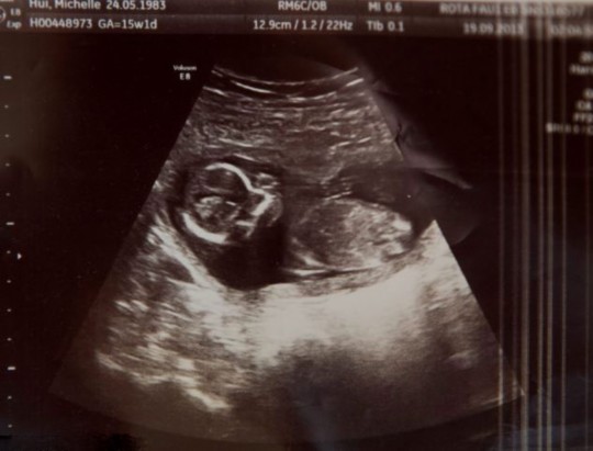 爱尔兰<em>女子</em>人工<em>流产</em>后 顽强婴儿奇迹存活(图)_