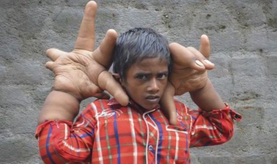 印度八岁男童长巨手每只重达8公斤 医生束手无策(组图)