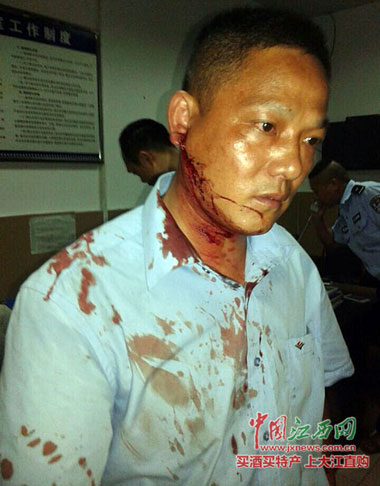 南昌保安队长以一敌三铁血斗窃贼 受伤被缝16