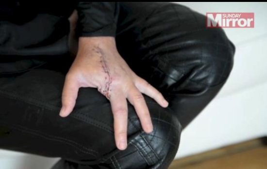 美发师被毒蜘蛛咬伤食指差点丧命 被迫截指保命