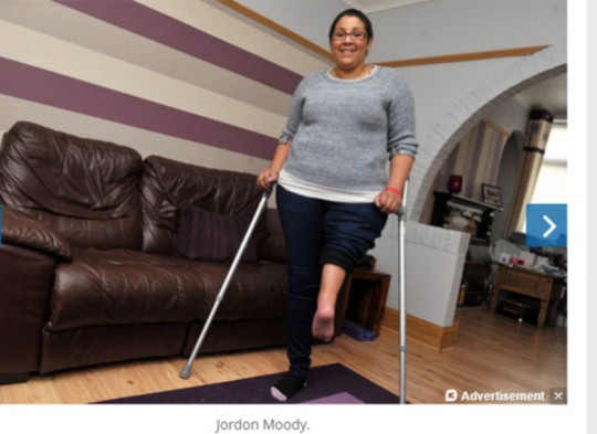 英骨癌女截肢又接回 脚跟翻转180度变膝盖(图