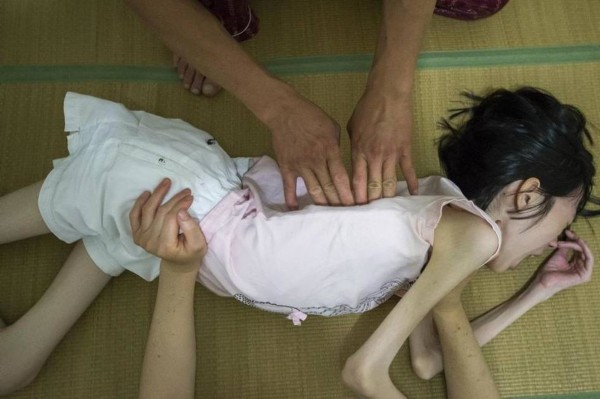 浙江脊肌萎缩症<em>女生</em>不 萎缩 拿不起一本书_在