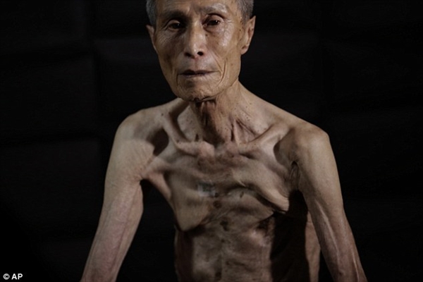 日本核爆幸存老人面貌曝光:骨瘦如柴伤痕累累