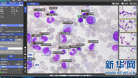圖為ai智能影像診斷系統識別出的骨髓細胞.