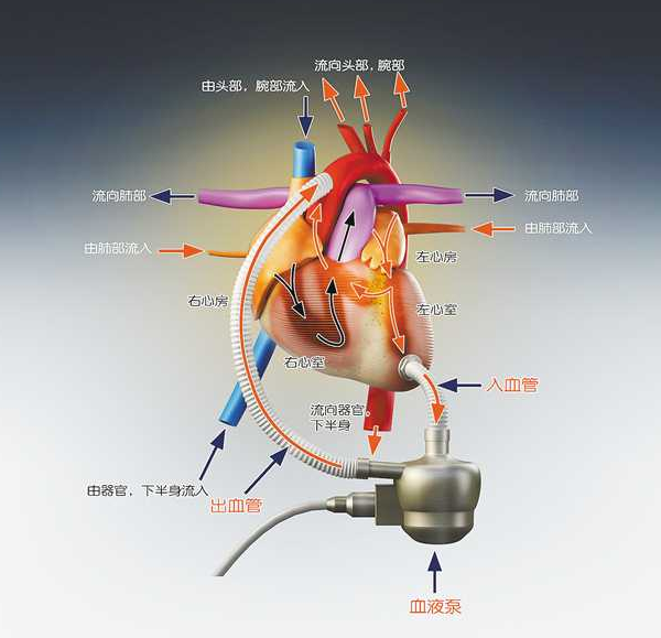 永仁心人工心脏的工作原理.(重庆永仁心公司供图)