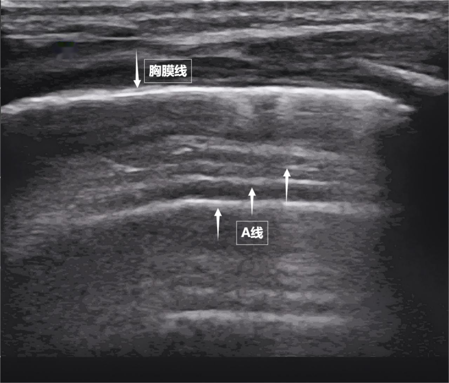 健康体检｜无声的声波 有形的肺