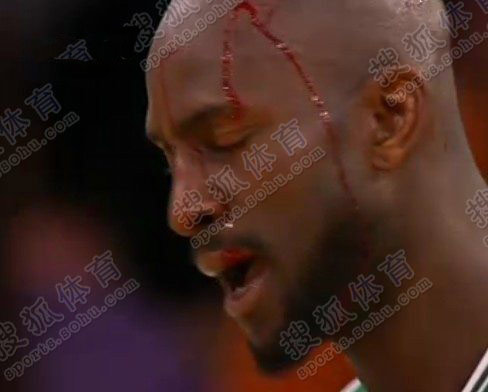 Kevin Garnett, de Lakers, está herido en la cabeza